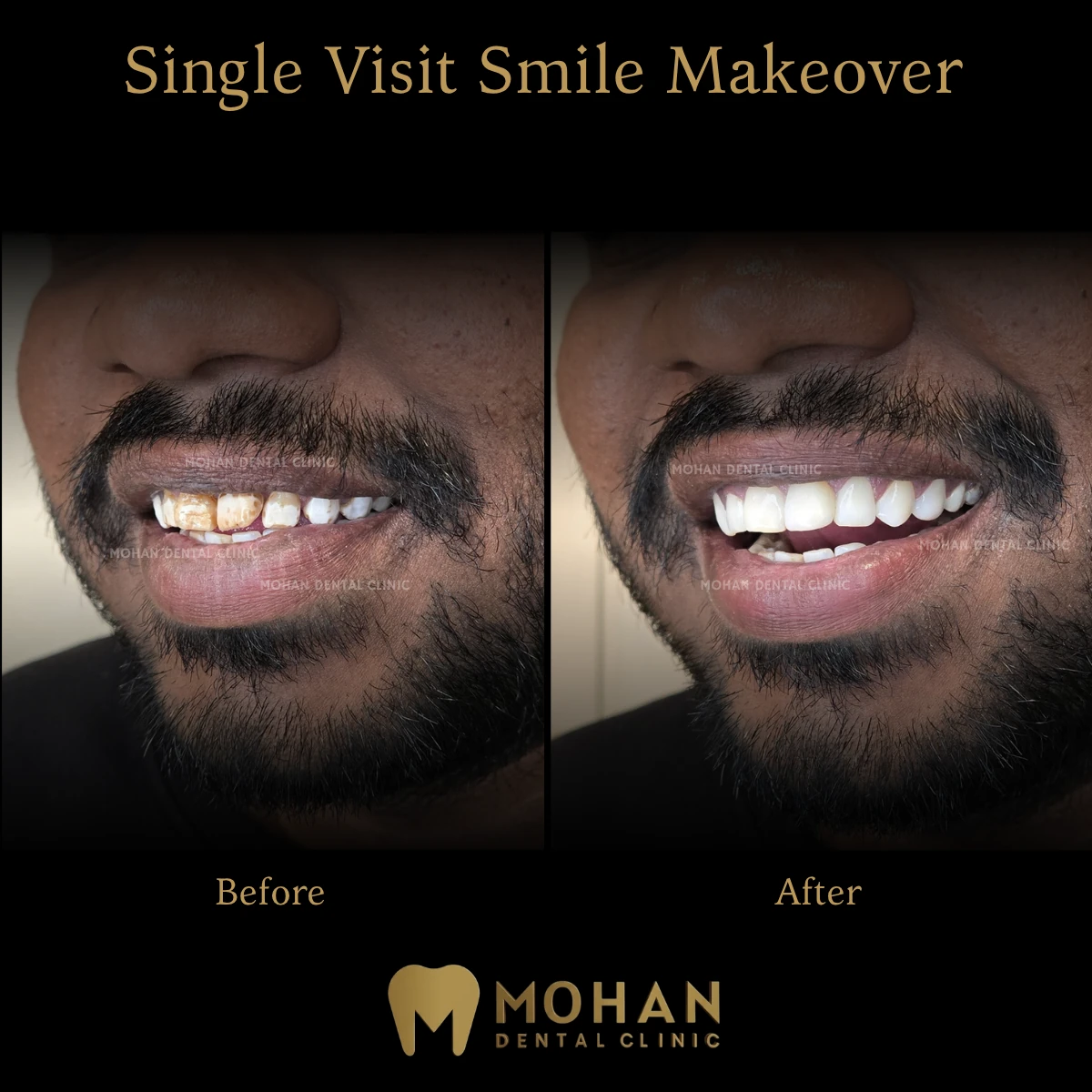 Before and after: single visit smile makeover, stained and worn teeth