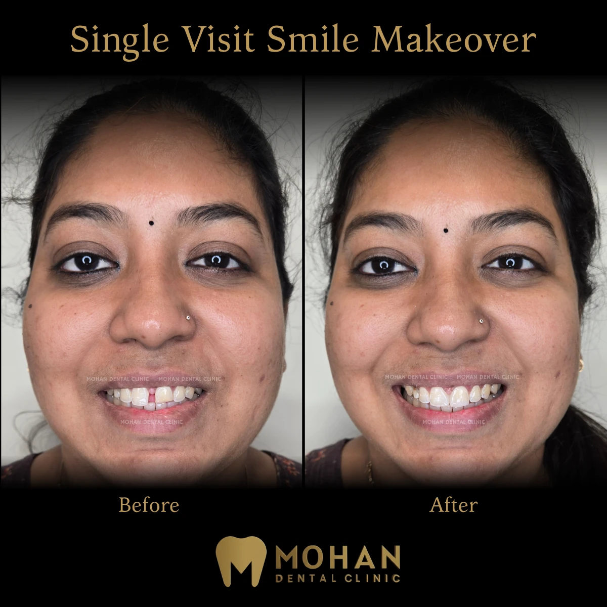 Real patient case, single visit smile makeover