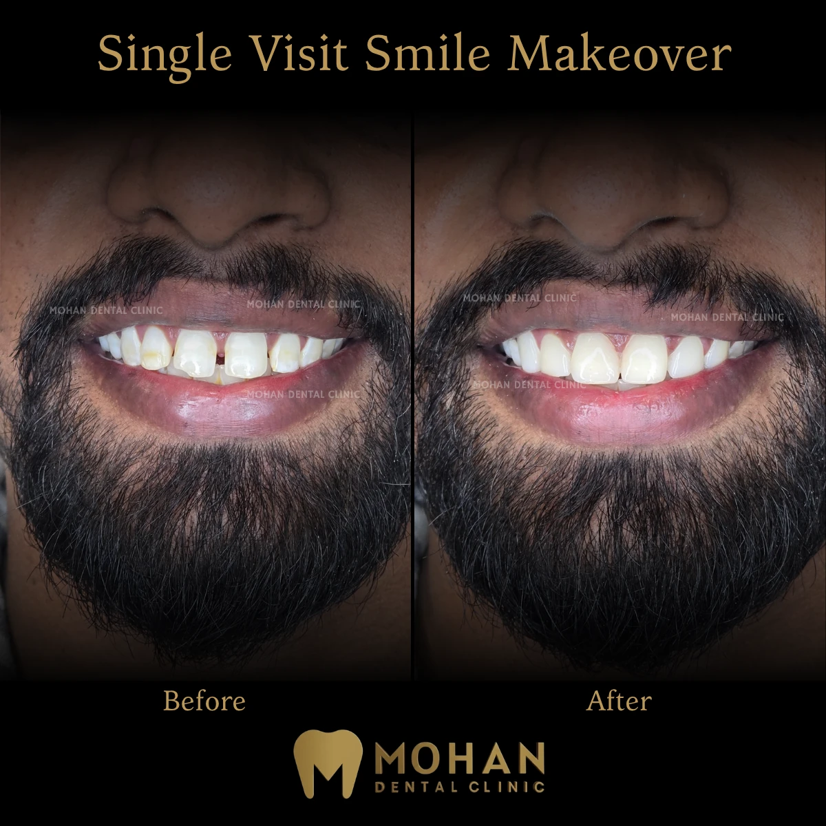 Before and after: single visit smile makeover, upper front teeth