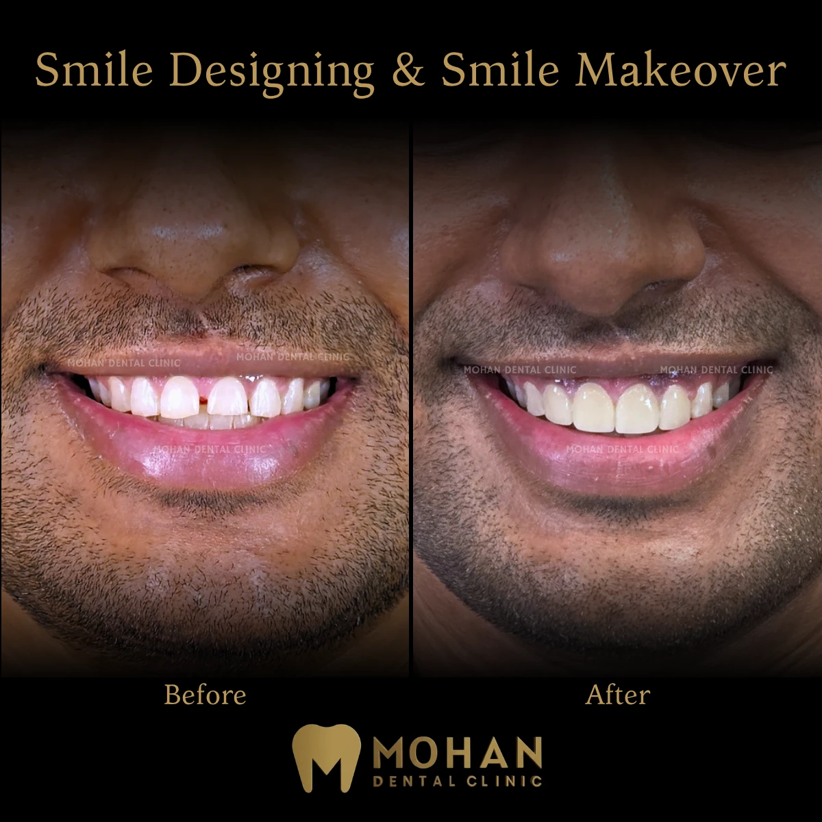 Before and after: smile designing and makeover, gap closure