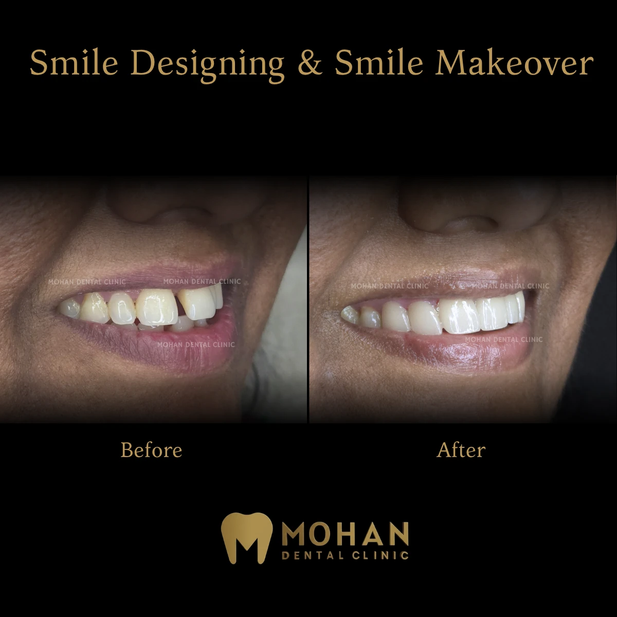 Before and after: smile designing and makeover, upper arch