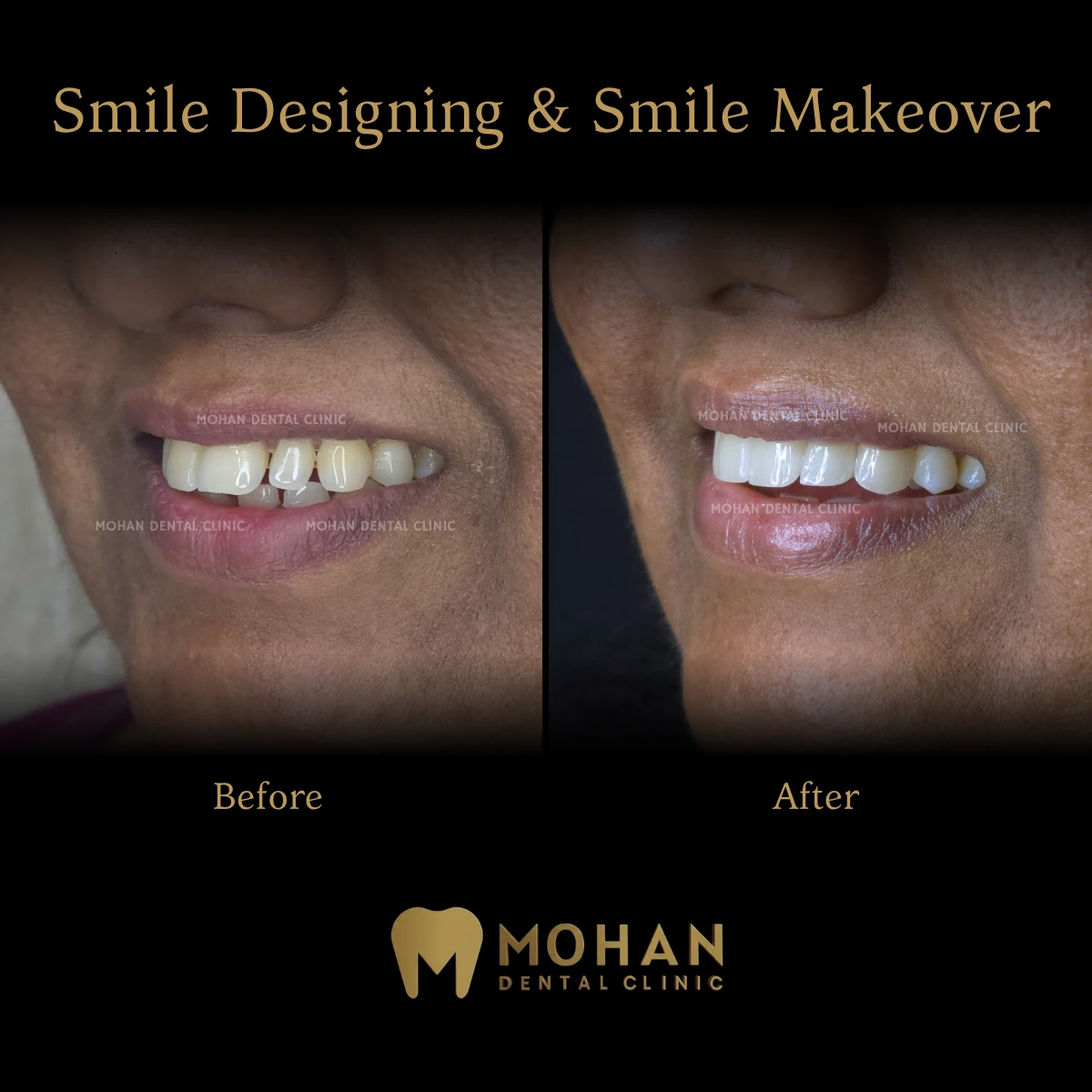 Before and after: smile designing and makeover, chipped front teeth